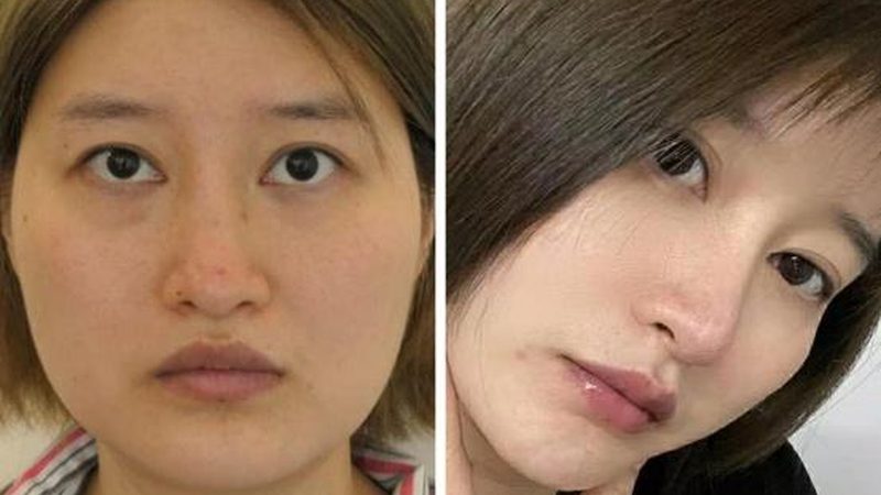 上海隆鼻医生硅胶和膨体怎么选