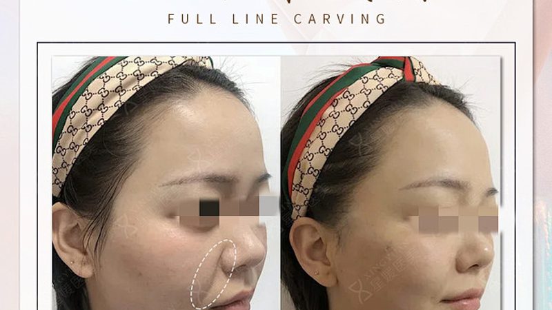 瘦脸操VS面部瑜伽：揭秘两种瘦脸方式的本质区别