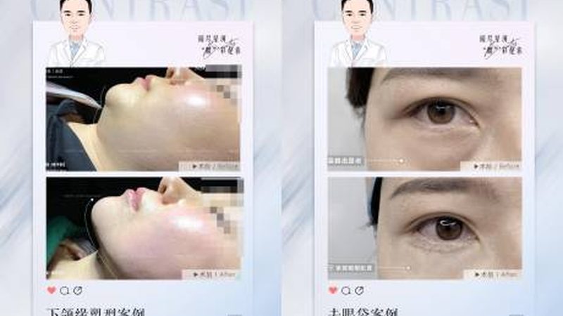 大V线与小V线：广州埋线提升的两大技术区别解析