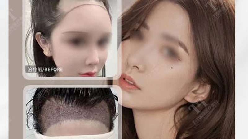 热玛吉900发，揭秘其价格背后的奥秘