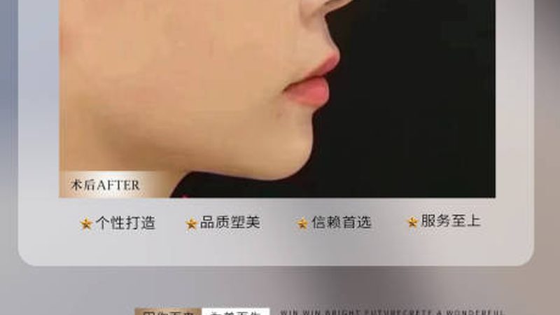肉毒素注射效果显现，揭秘最佳时间点