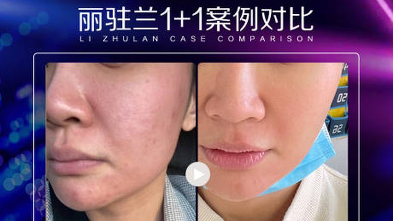激光美容仪器分类及规格揭秘：如何选择适合自己的设备