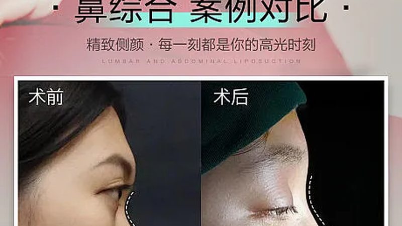 激光祛雀斑，揭秘上海优质医院的选择标准
