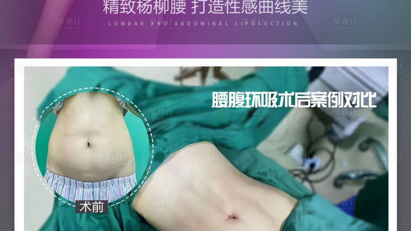 全切和埋线到底怎么选，广州医生推荐看这几点