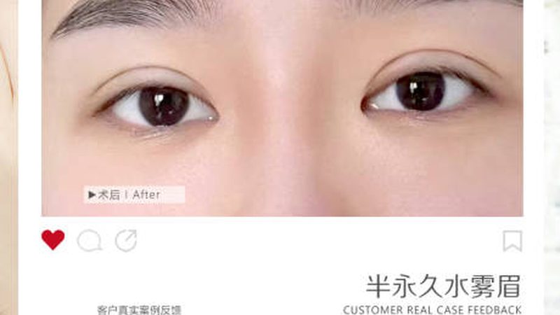 小型IPL激光祛斑仪：揭秘其价格背后的秘密